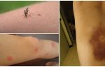 Per què queden contusions després de les picades de mosquits?